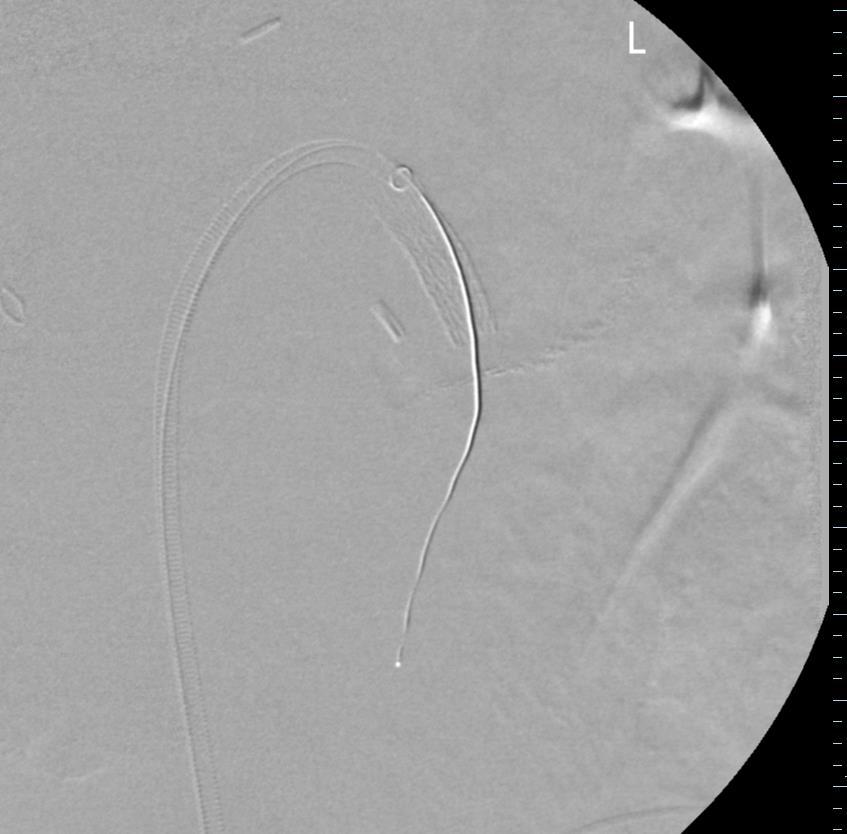 Post covered stent angiogram Note: