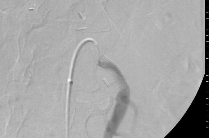 09/15/14 Selective SMA angiogram demonstrates persistent filling