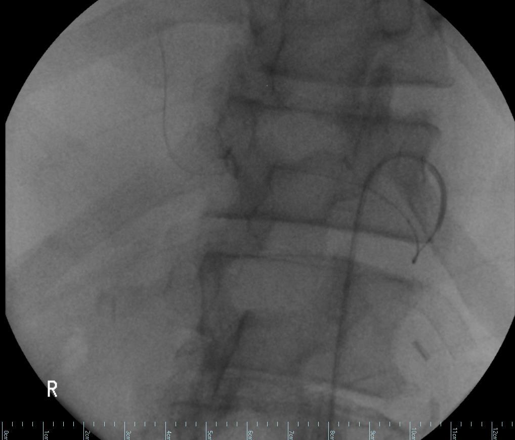 Multiple attempts to selectively catheterize the SMA branch
