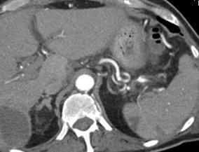 09/19/14 CT of the abdomen shows a pseudoaneurysm arising from a branch of the anterior aspect of the proximal splenic artery and a small branch arising from the superior mesenteric artery with its