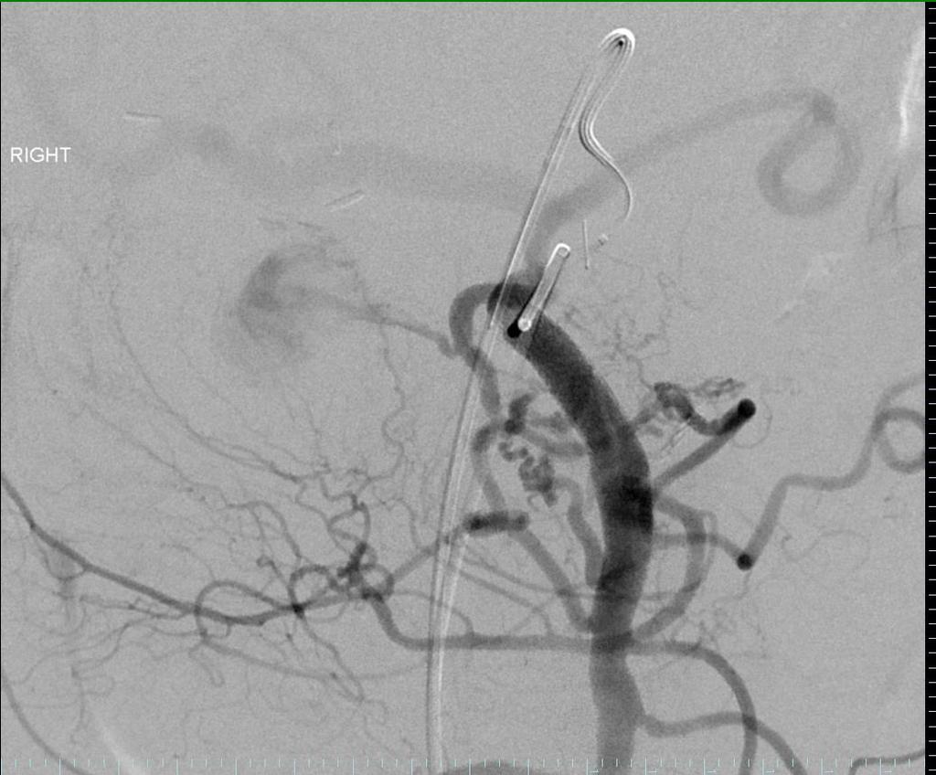 09/22/14 SMA angiogram shows filling of the pseudoaneurysm from a branch of