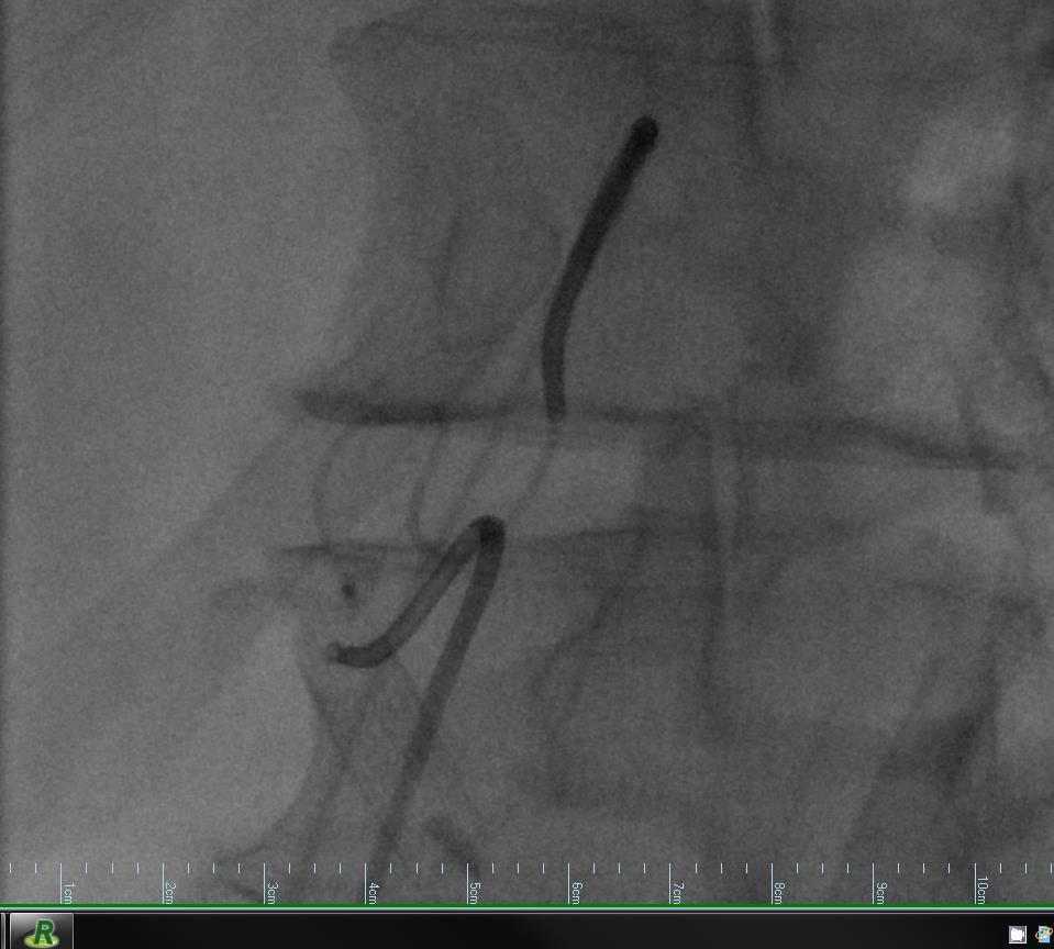 Microcatheter advanced through celiac access is able to reach the vessel feeding the pseudoaneurysm with