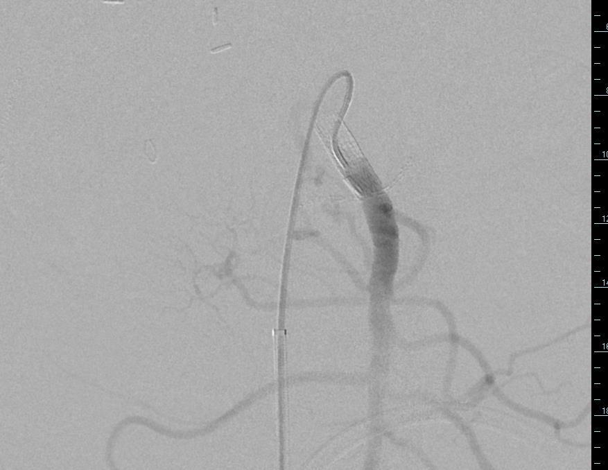 09/25/14 SMA angiogram clearly demonstrates filling of the pseudoaneurysm via a branch of the SMA which in