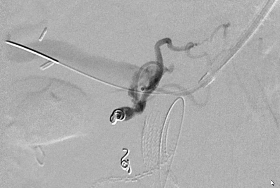 Successful coil embolization performed of the proximal splenic artery