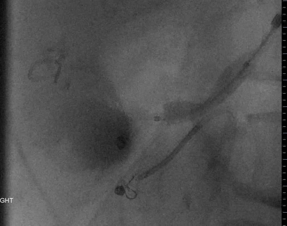 6 x 27 mm stent