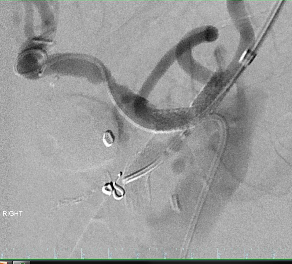 Since the major collateral to the celiac access from the SMA was embolized, it was necessary to stent the