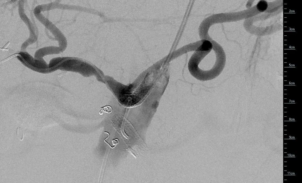 Stenting of the celiac origin using a 6mm diameter by 27mm balloon expandable