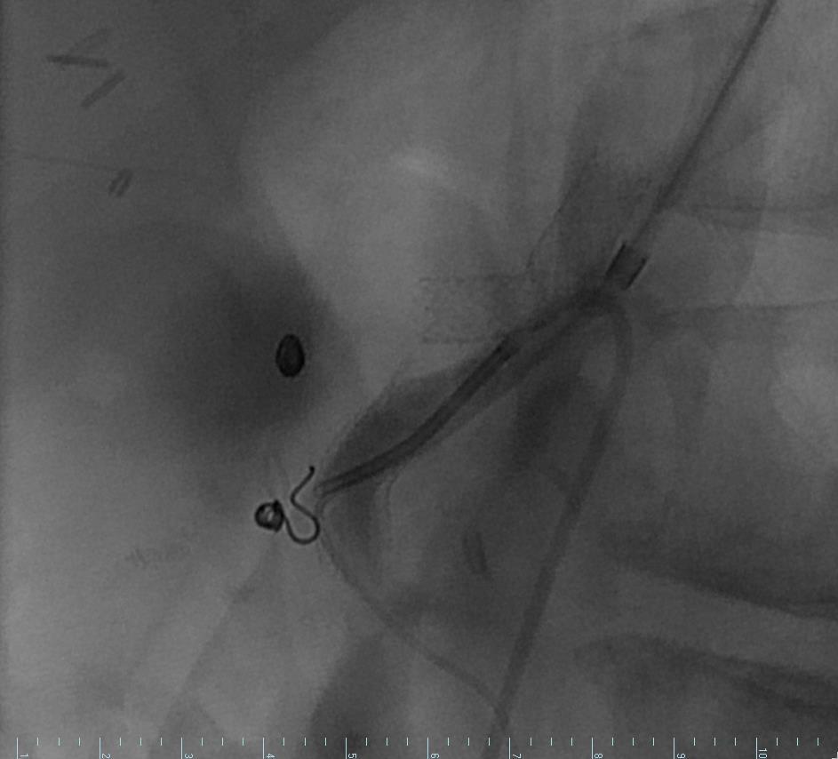 Selective superior mesenteric angiogram reveals slow flow within the mesenteric artery as well as compression of