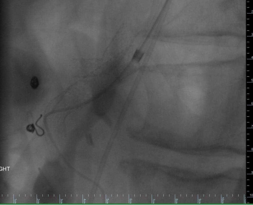 SMA angiogram shows brisk flow following 8 x 27 mm balloon