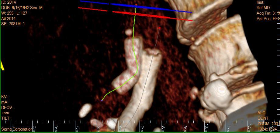 3d CT reveals proximity of SMA and celiac to explain