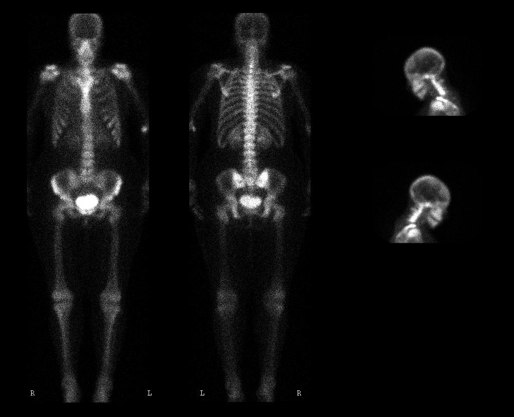 Bone Scan 33 y/o woman, infiltrating ductal carcinoma, s/p partial
