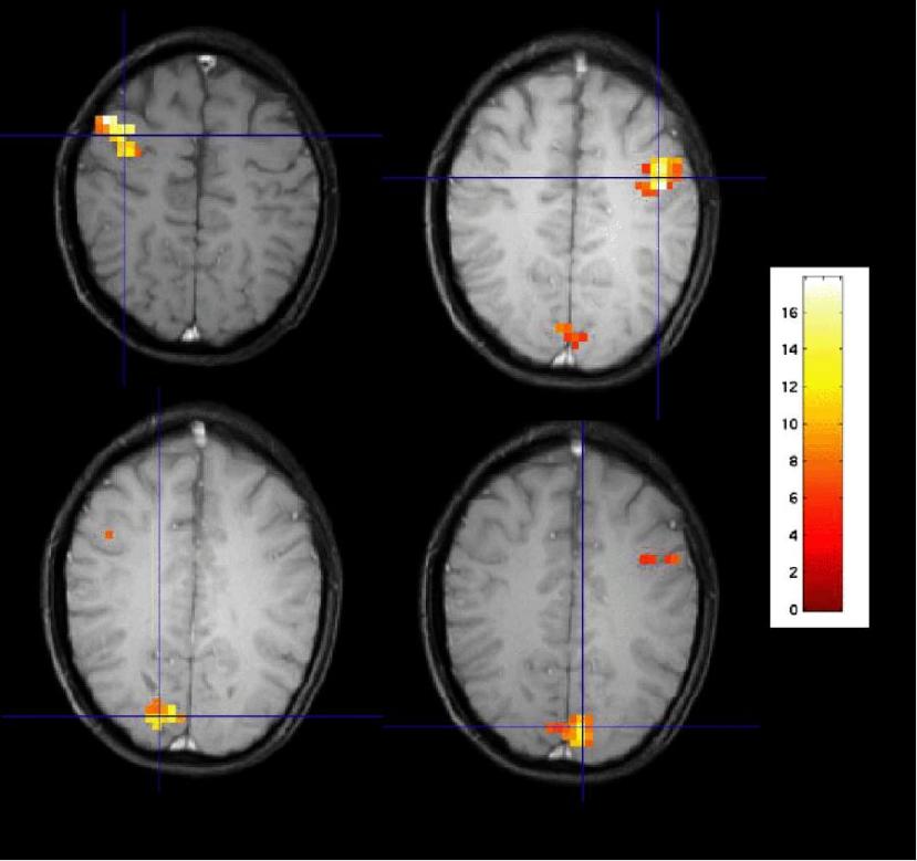 Elements of Functional Neuroimaging 27 brain within an individual and across individuals (Aguirre et al., 1998; Schacter, Buckner, Koutstaal, Dale, & Rosen, 1997).