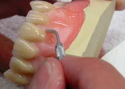 Add contouring resin to the denture body using the electrical wax knife.