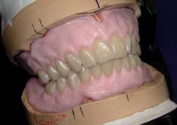 Full dentures Avoid overcontouring. Use a clean, pointed, hard instrument for modelling.