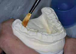 it should run approximately mm below the tooth equator. Apply a wax cuff that follows this line exactly.