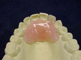 Allow the denture to cool. Remove from the cast.