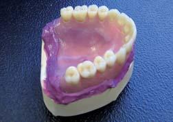 Rebasing Create a split-cast working cast for the denture to
