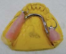 Remove the denture base from the cast, finish the margins and roughen the surface of the baseplate.