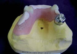 Clean the base first with water and then with propanole. Allow the cast to dry. Boil out the denture teeth to completely remove all residual ways.