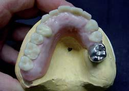 Add contouring resin even on the palatal aspect, including the interdental spaces.