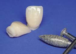 Complete dentures 0 Boil out the denture teeth to completely remove all residual ways.