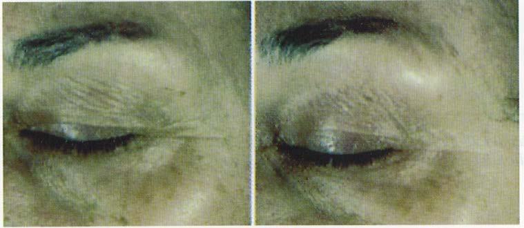 2 Wrinkles Reduction (In vivo test on 3 patients) Test Protocol : same as Test 1 : Comparative observation between 3