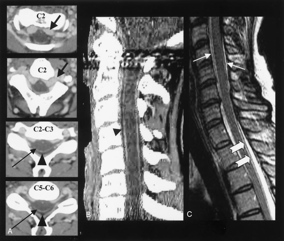 AJNR: 26, January 2005 INTRADURAL SPINAL VEIN ENLARGEMENT 35 FIG 1. Cervicothoracic epidural pseudomeningocele with dilated cervical epidural venous plexus and spinal dural enhancement.