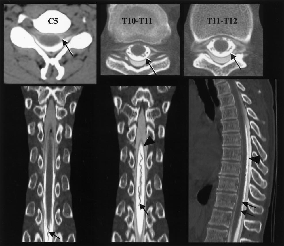 36 BURTIS AJNR: 26, January 2005 FIG 2. Large epidural pseudomeningocele and dilated posterior thoracic spinal vein.