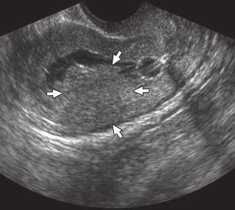 Twenty-three of the 26 women (88%) had SHG findings suggestive of adenomyosis. In the other three women (12%), adenomyosis was identified at MRI performed after SHG.
