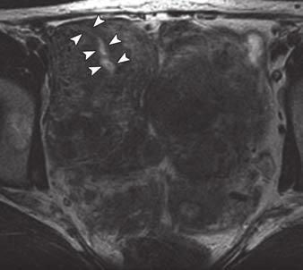 In addition to focal adenomyosis, MRI also confirmed the presence of two small mural fibroids (Fig. 6). In the third woman, MRI did not show adenomyosis but did show a dominant mural fibroid.