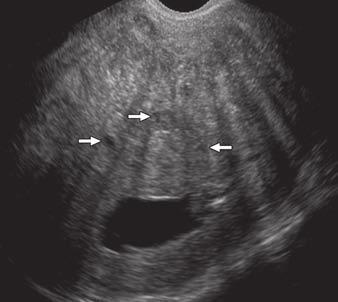 Sonohysterography and MRI of denomyosis Fig. 5 46-year-old woman with menorrhagia.