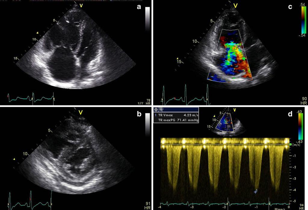 518 Neth Heart J (2011) 19:514 522 Fig. 2 Chest X-ray of a PAH patient showing a prominent pulmonary artery and enlargement of the right atrium and right ventricle.