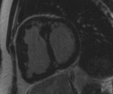 Neth Heart J (2011) 19:514 522 519 Fig. 4 Cardiac MRI of a PAH patient showing a wide and hypertrophied right ventricle and flattening of the intraventricular septum.