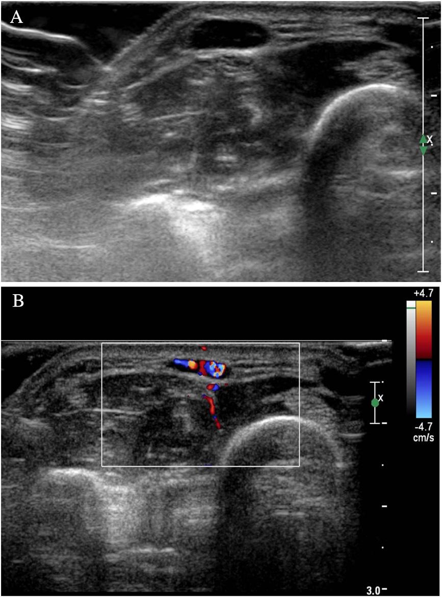 Lee et al. Journal of Medical Case Reports Page 3 of 6 Fig. 2 Ultrasonograms of the mass lesion. a Ultrasonogram of the forearm shows a well-defined, hypoechoic, 0.9cm soft tissue nodule.