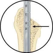 Addressing Surgical Technique STEP 1. RESECT FEMORAL NECK WITH THE OSTEOTOMY GUIDE.