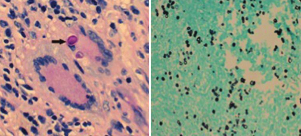 The scess displyed shrp order with the underlying gliotic rin tissue.