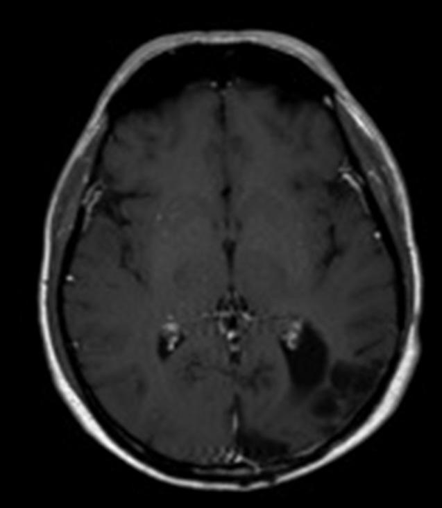 Surgicl Neurology Interntionl 2015, 6:174 http://www.surgiclneurologyint.