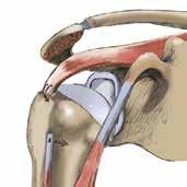 What is biceps surgery? Biceps surgery is performed arthroscopically, that is, without opening the joint. Two or three small 5-mm incisions are made around the shoulder.