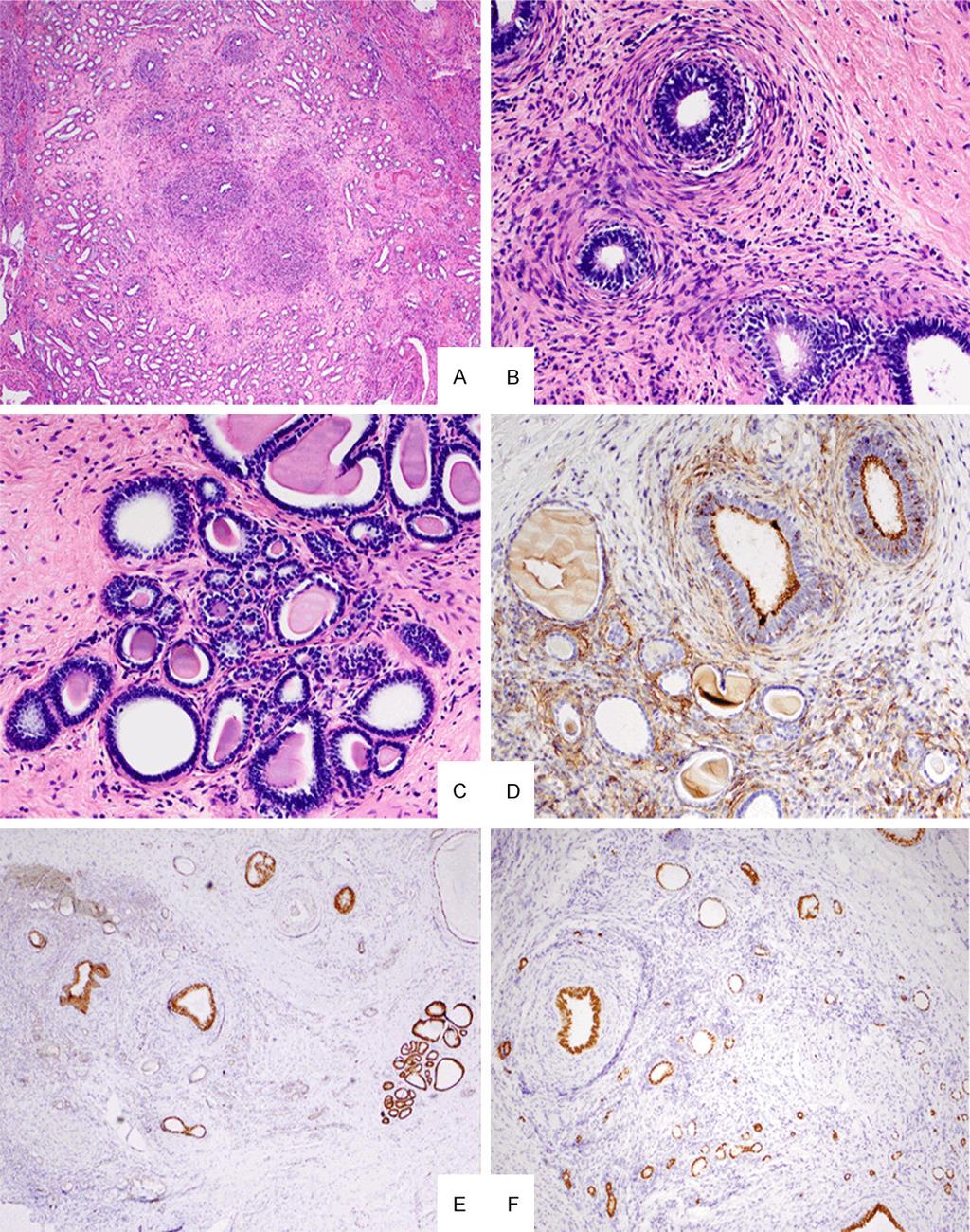 Figure 1. A. Mesonephric remnants are organized in a lobular pattern and located in renal medulla. B.