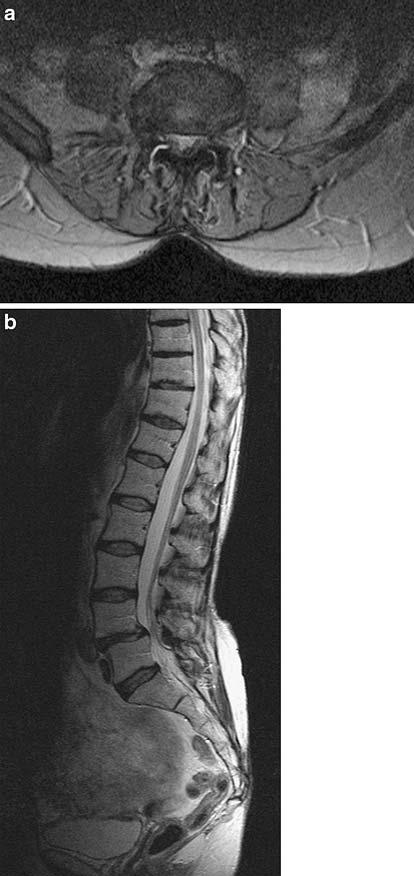 Eur Spine J (2008) 17:188 192 191 Fig. 3 Post-operative T2-weighted a transversal and b sagittal MR Image.