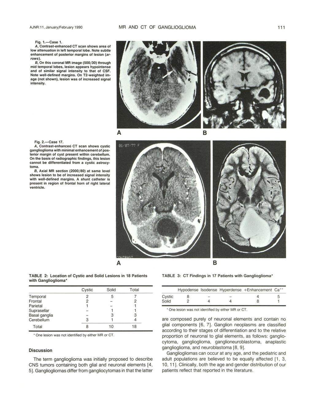 JNR :11, January/February 1990 MR ND CT OF GNGLIOGLIOM 111 Fig. 1.-Case 1., Contrast-enhanced CT scan shows area of low attenuation in left temporal lobe.