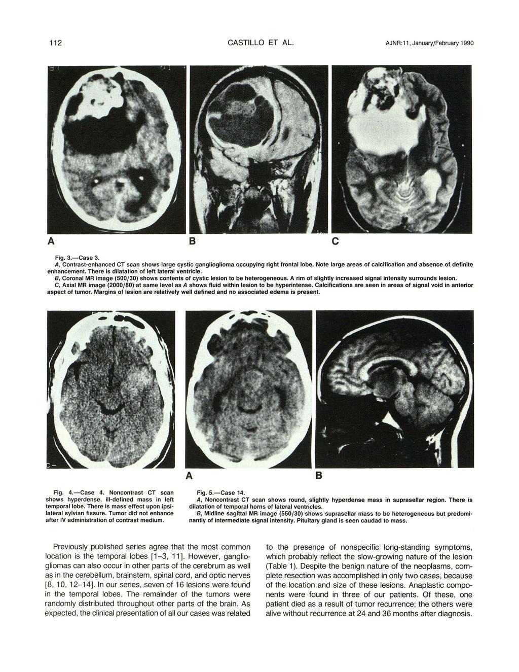112 CSTILLO ET L. JNR:11, January/February 1990 c Fig. 3.-Case 3., Contrast-enhanced CT scan shows large cystic ganglioglioma occupying right frontal lobe.