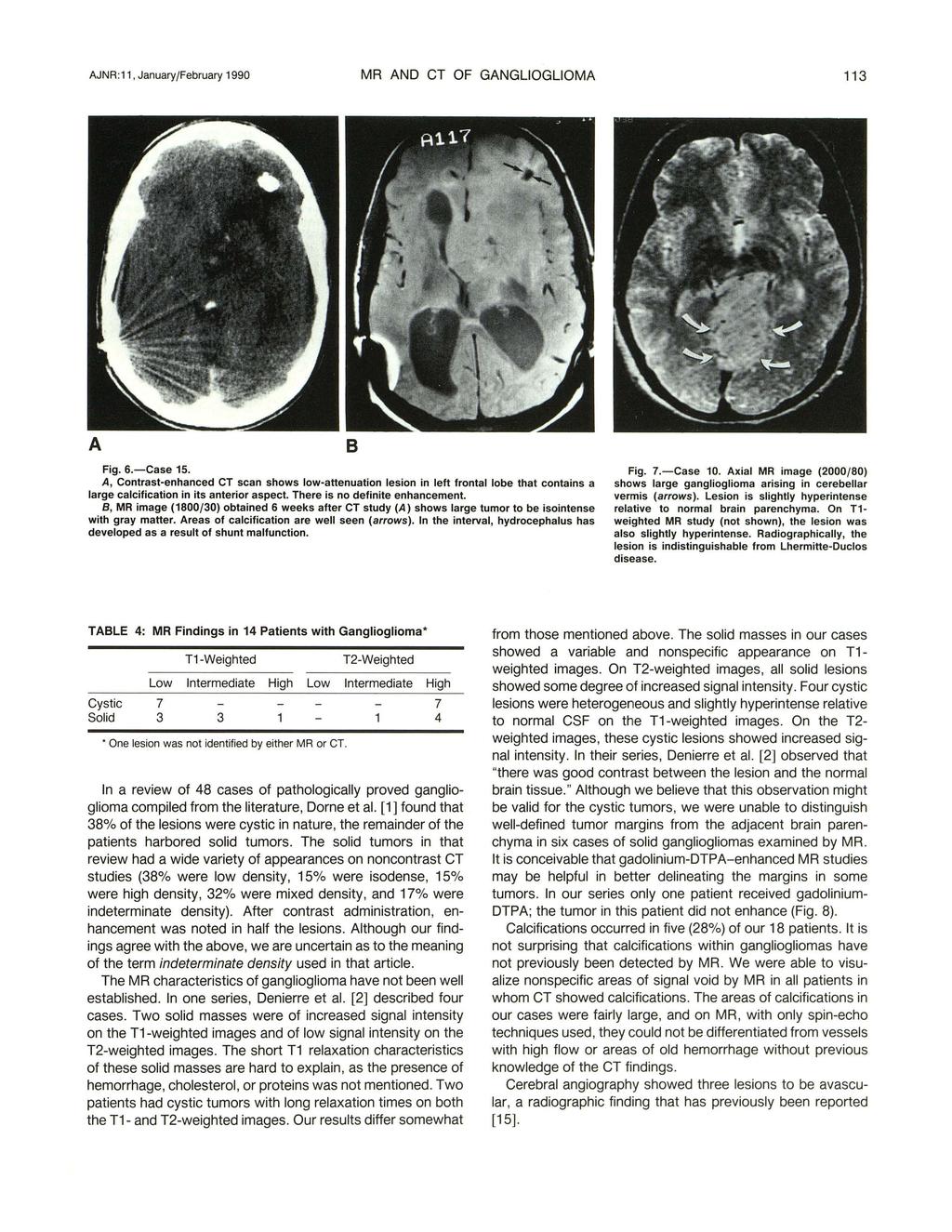 JNR:11, January/February 1990 MR ND CT OF GNGLIOGLIOM 113 Fig. 6.-Case 15.