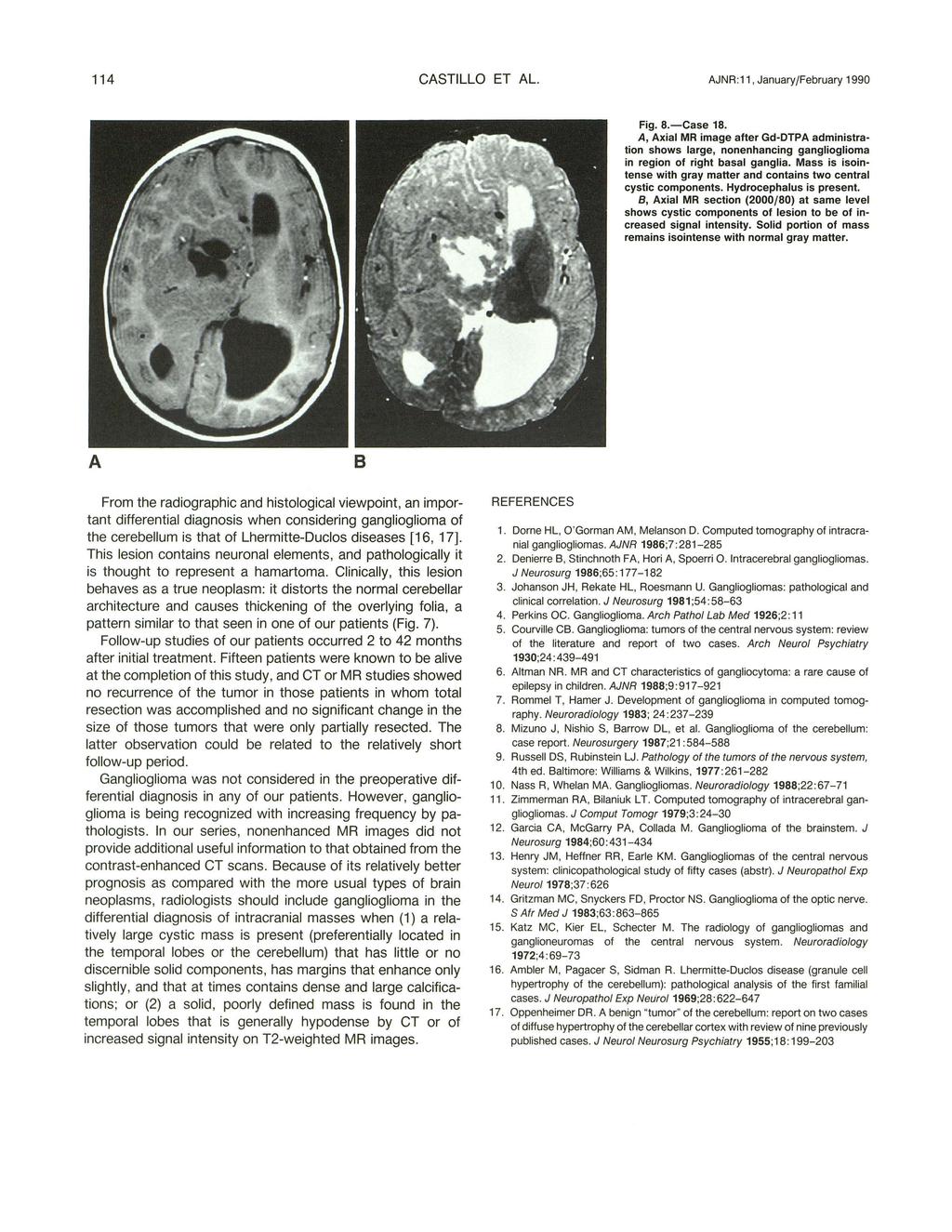 114 CSTILLO ET L. JNR:11, January/February 1990 Fig. 8.-Case 18., xial MR image after Gd-DTP administration shows large, nonenhancing ganglioglioma in region of right basal ganglia.