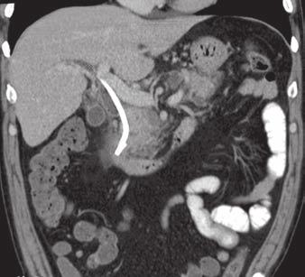 MDCT of iliary and Gastrointestinal Stents D E Fig.