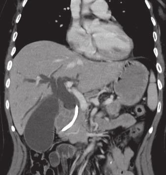 2 42-year-old woman with pancreatic head adenocarcinoma and biliary stent that was misplaced in