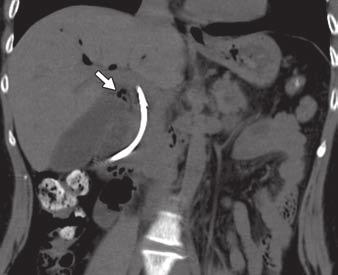 , Conventional abdominal radiograph obtained immediately after placement of plastic biliary
