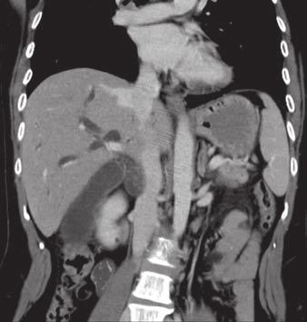 eccentrically placed in biliary duct.