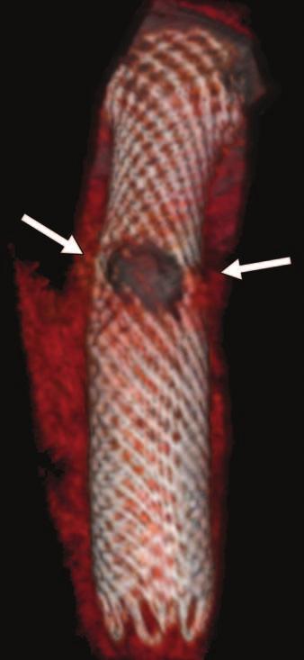 air-filled recess (arrow) adjacent to duodenal stent.