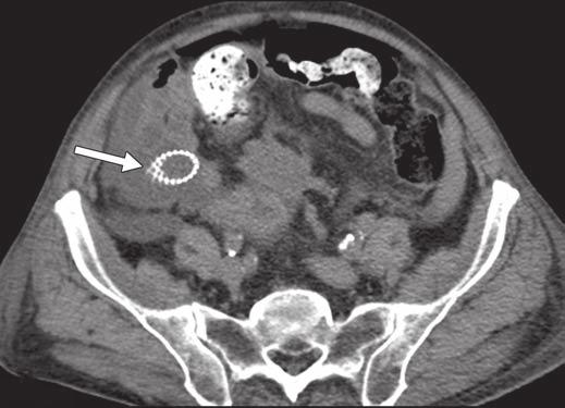 and C, CT scans show sigmoid colon thickening (black arrows, C) and that
